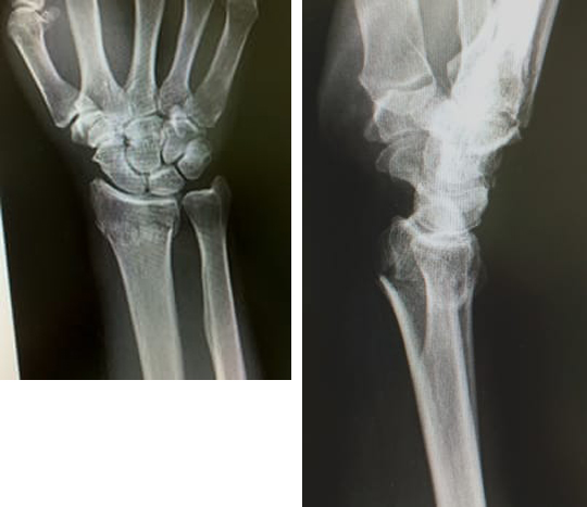 手関節の骨折レントゲン写真